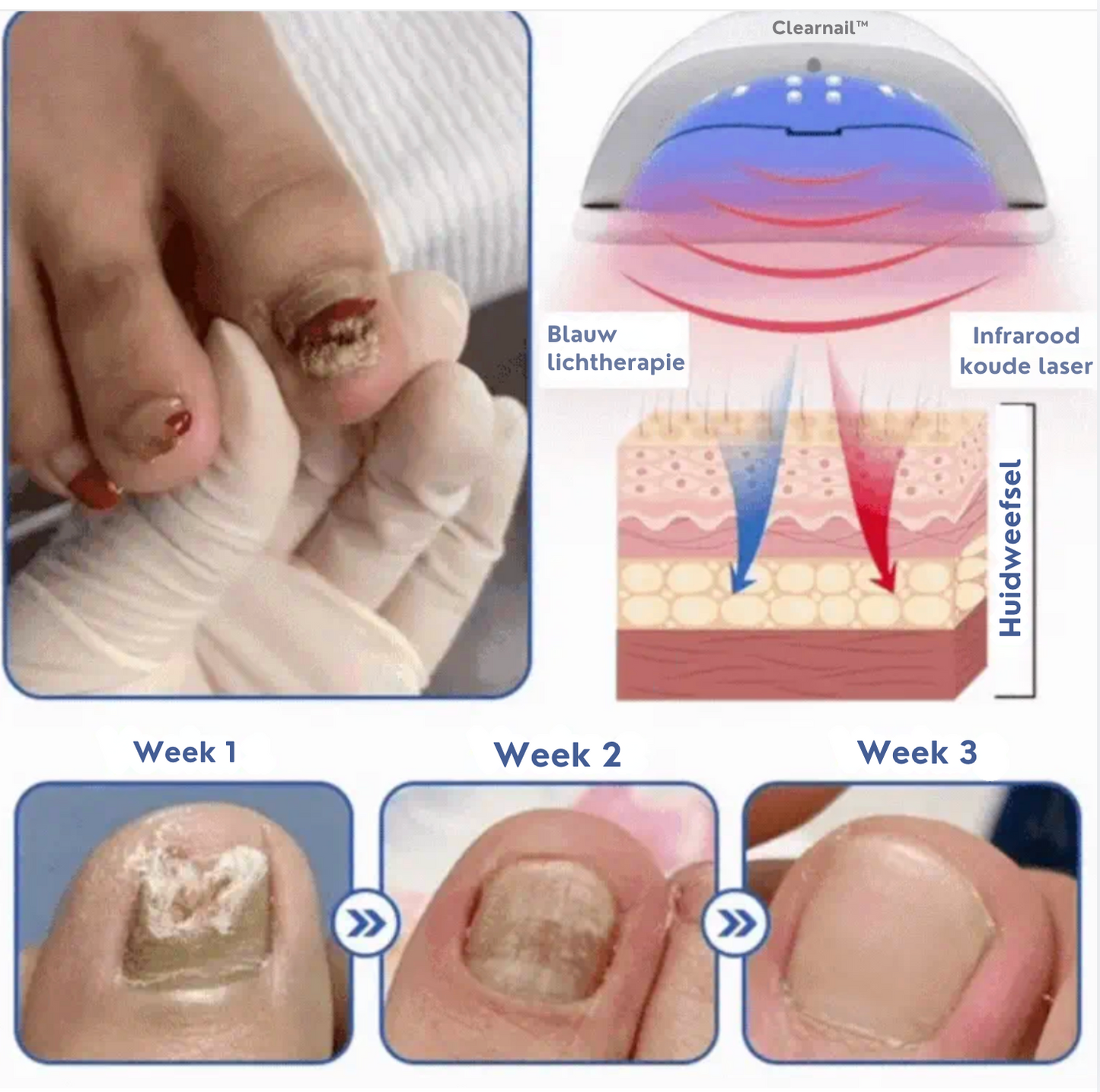 Clearnail™ | Durf Je Nagels Weer te Laten Zien, oplossing tegen Schimmelnagels!
